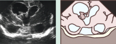 Hemorragia intracraniana fetal